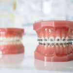 How Braces Can Improve Oral Health Beyond Aesthetics