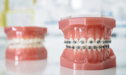 How Braces Can Improve Oral Health Beyond Aesthetics
