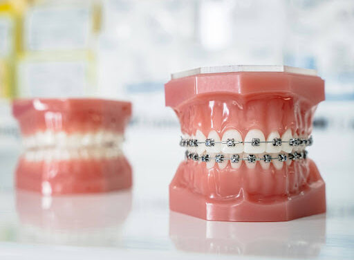 How Braces Can Improve Oral Health Beyond Aesthetics