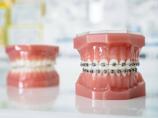 How Braces Can Improve Oral Health Beyond Aesthetics